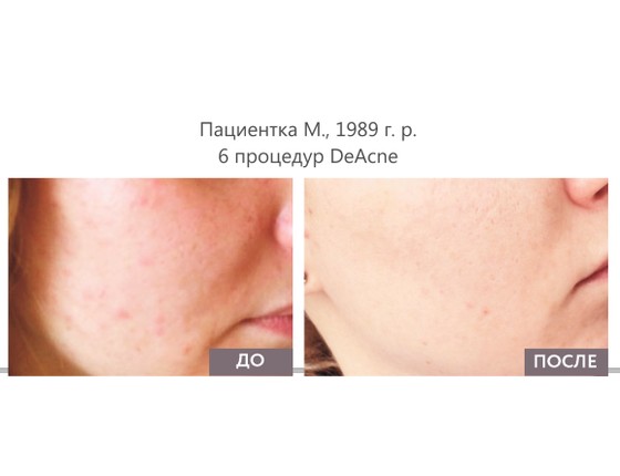 DeAcne